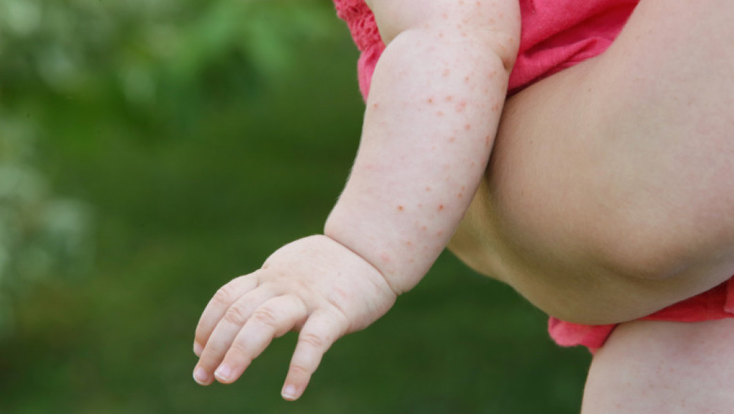 Epidemie gravă de rujeolă în Statele Unite în 2025