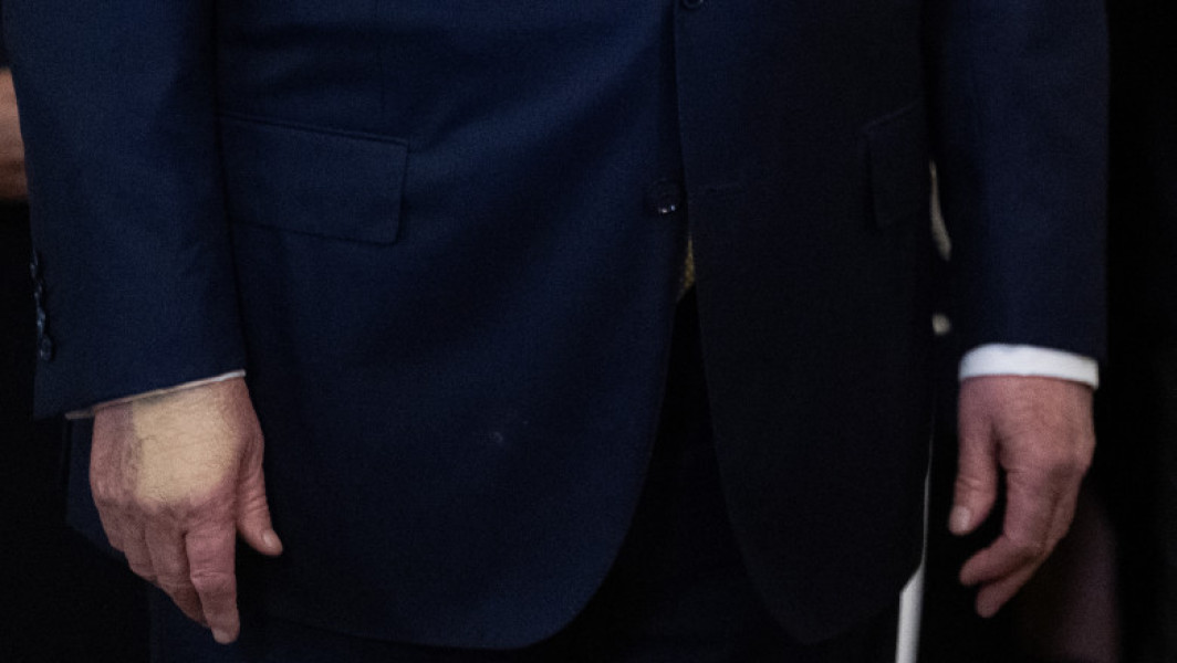 donald trump a fost diagnosticat cu insuficiență venoasă cronică